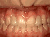 missing later incisors - after
