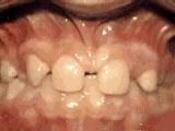 missing later incisors - before