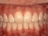 overbite - after